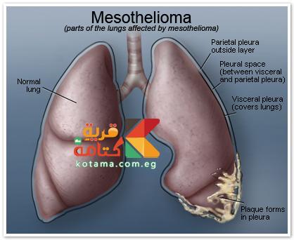 mesothelioma